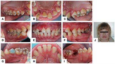 Hermansky-Pudlak syndrome type 2: A rare cause of severe periodontitis in adolescents—A case study